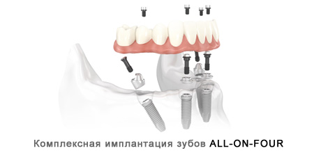 Имплантация зубов - имплантация all-on-4