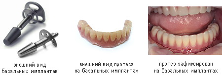 Базальная имплантология зубов